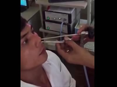 Vietnamese doctor removes live leech after it crawls up man's nose
