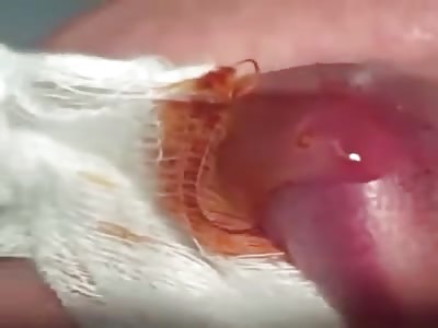 Botfly larvae removal from man's lip.