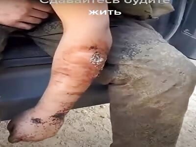 Russian Soldier With Maggots In His Arm.