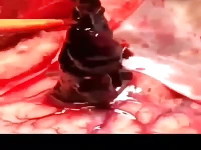 Massive bloodclots extruded from man's brain. 