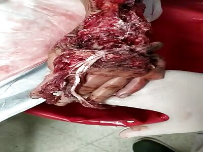 Meat Grinder Hand Injuries.