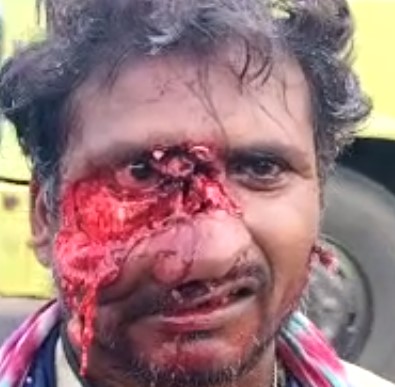 Horrible Accident Turned His Face into Halloween Mask