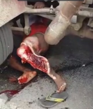 man with skinned leg under truck