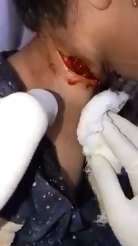 Hard to Watch Video of Child with a Slit Neck 