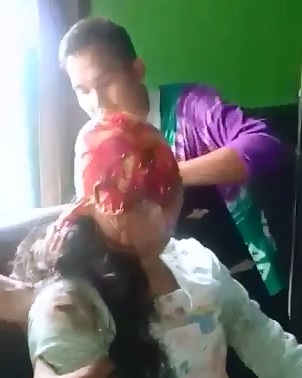 Ridiculous..Girl was Scalped to the Bone in a boating accident in Indonesia leaving her in State of Shock ...(Warning)
