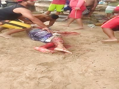 Shark Attack Victim Quivers on the Sandy Breach 