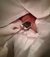 Woman Has Cell Phone Shoved up Her Ass Surgically Removed