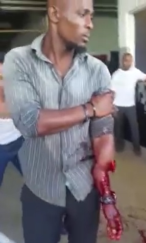 FULL VIDEO: Very Calm Man Loses His Arm During Fight