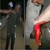 Hand Hanging by a String after Machete Attack
