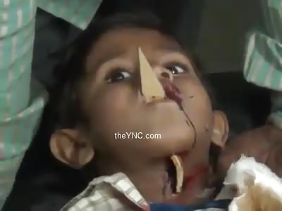 The Child With A Tip Of A Fence Impaled On His Neck And Mouth