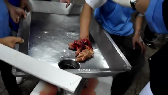 The Young Man's Hand Crushed In A Meat Grinder Machine