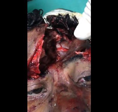 Now That's a Close Up: Guy Almost Put the Camera Inside Hole in Man's Head