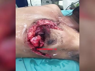 OPEN CHEST SURGERY AFTER BEING INJURED