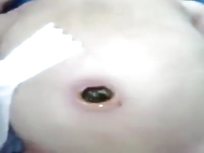 Baby With Worms in the Belly Button