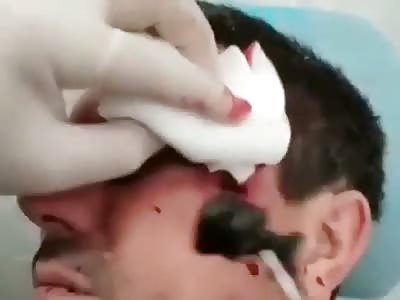Removing bullet from face