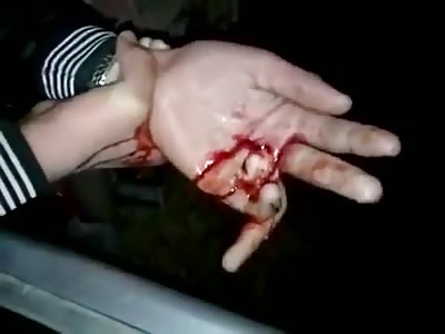  Injured Hand With Broken Finger!
