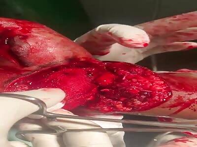 Surgeon examines shattered hand.