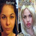 Ever Thought About Plastic Surgery? These 21 Disasters Will Change You Mind Forever