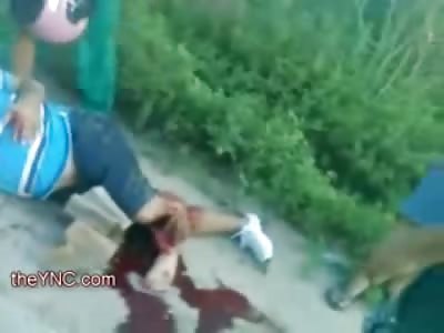 Man with Severed Shocking Leg Trauma makes the Best of It