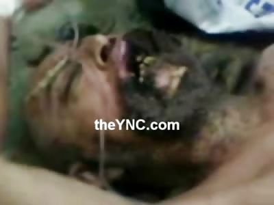 GOOD GOD!! Man still Alive has his Jaw being Devoured by Worms and Maggots.....