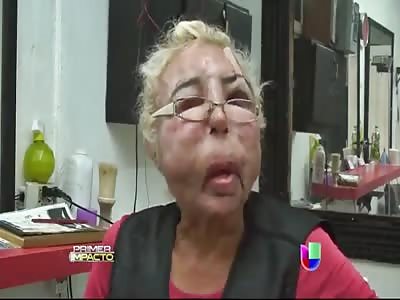 Mexican Gay Addicted to Plastic Surgeries Ends with Face Totally Disfigured